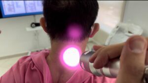 laser treatment